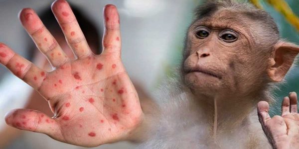 Detectan tres casos de viruela del mono en Sevilla
