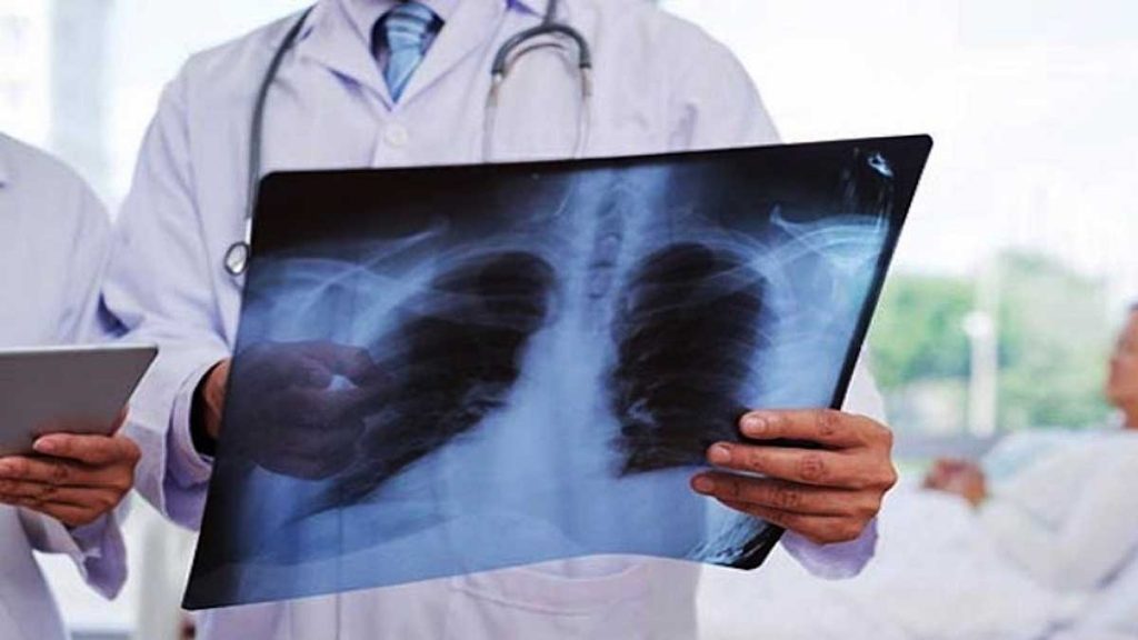 Médico con una radiografía de pulmones.
