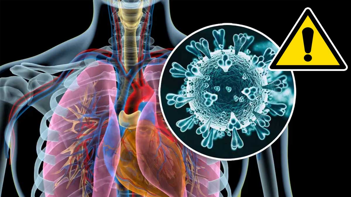 El metapneumovirus.